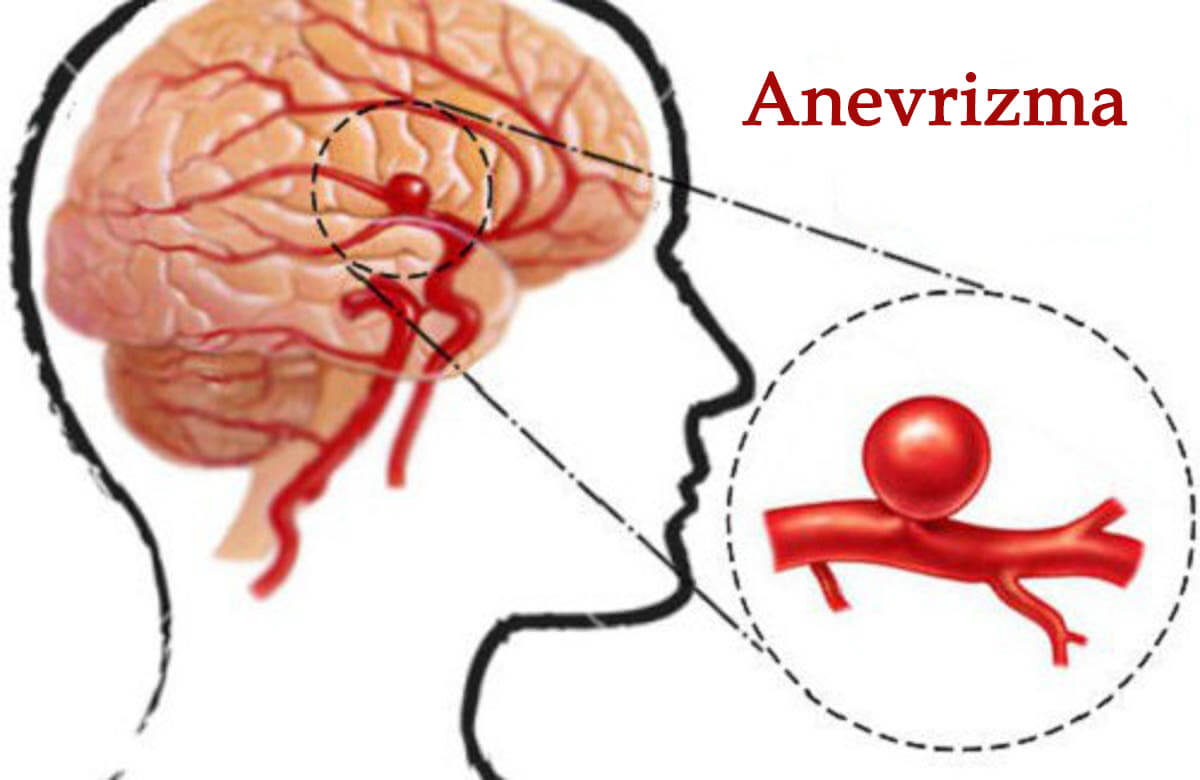 Beyin Anevrizması
